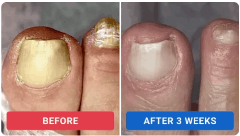 Oroville Nail Fungus Pen Review