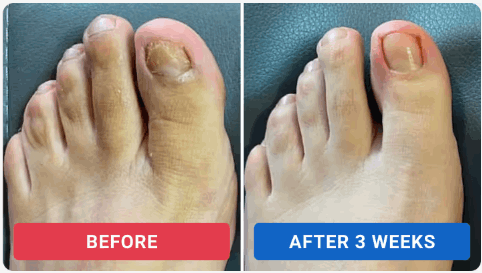 Oroville Nail Fungus Pen Reviews