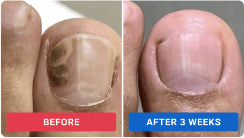 Oroville Nail Fungus Pen User Review